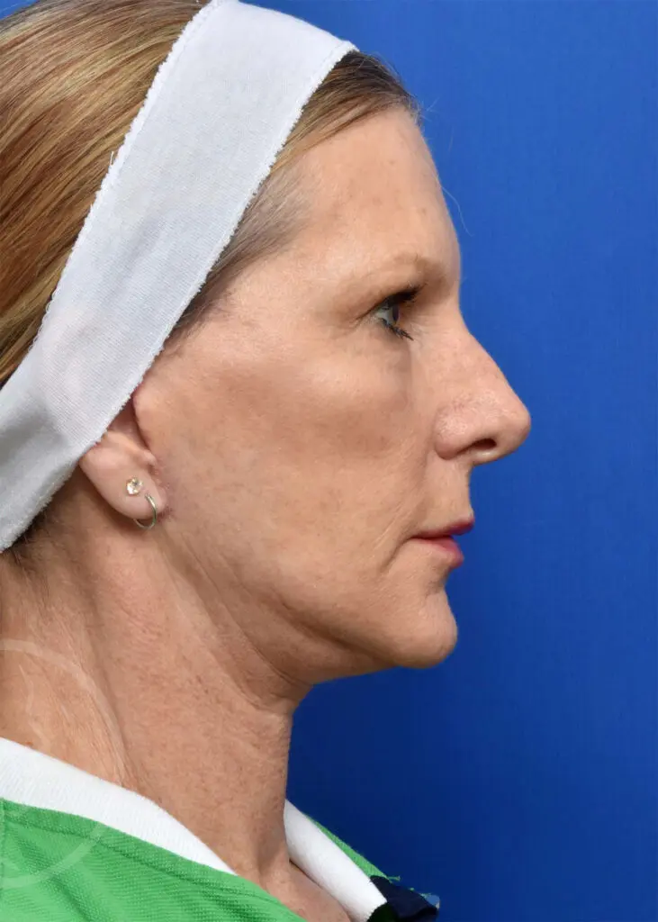 Plastic Surgery Before and After Pictures in Jacksonville, FL - Garcia Facial Plastic Surgery