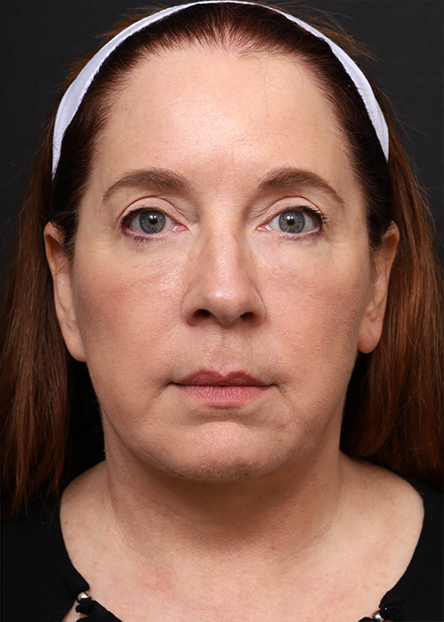 Plastic Surgery Before and After Pictures in Jacksonville, FL - Garcia Facial Plastic Surgery