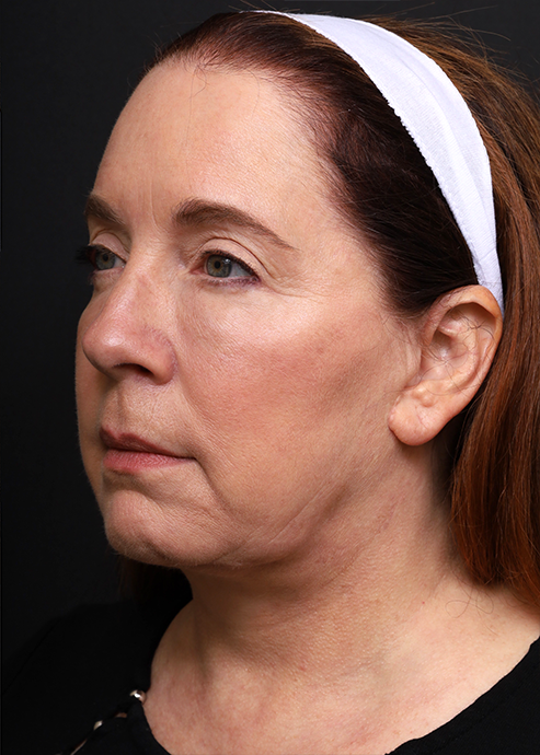 Plastic Surgery Before and After Pictures in Jacksonville, FL - Garcia Facial Plastic Surgery