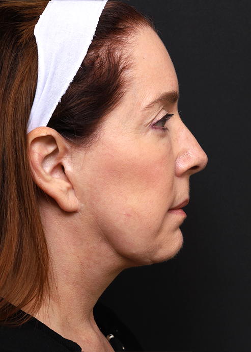 Plastic Surgery Before and After Pictures in Jacksonville, FL - Garcia Facial Plastic Surgery