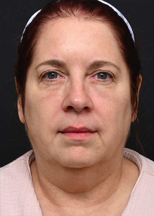 Plastic Surgery Before and After Pictures in Jacksonville, FL - Garcia Facial Plastic Surgery