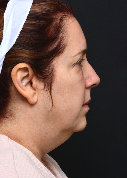 Plastic Surgery Before and After Pictures in Jacksonville, FL - Garcia Facial Plastic Surgery
