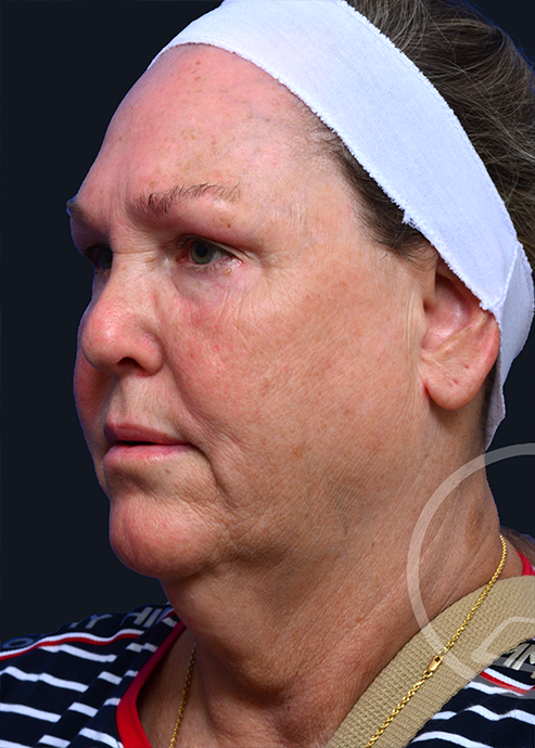 Plastic Surgery Before and After Pictures in Jacksonville, FL - Garcia Facial Plastic Surgery