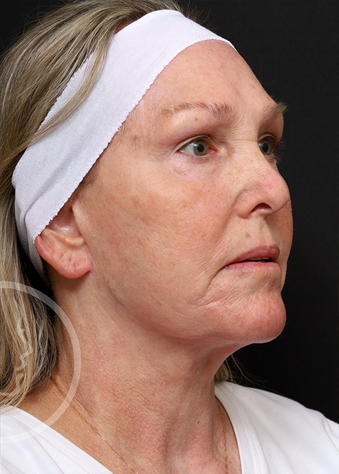 Plastic Surgery Before and After Pictures in Jacksonville, FL - Garcia Facial Plastic Surgery