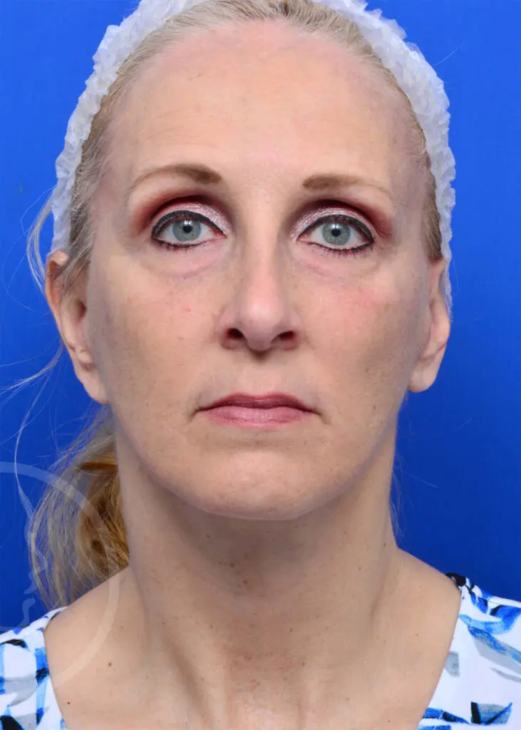 Plastic Surgery Before and After Pictures in Jacksonville, FL - Garcia Facial Plastic Surgery