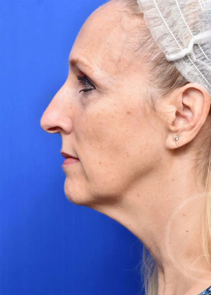 Plastic Surgery Before and After Pictures in Jacksonville, FL - Garcia Facial Plastic Surgery