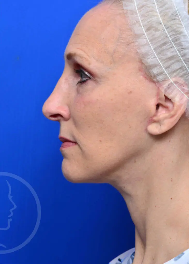 Plastic Surgery Before and After Pictures in Jacksonville, FL - Garcia Facial Plastic Surgery