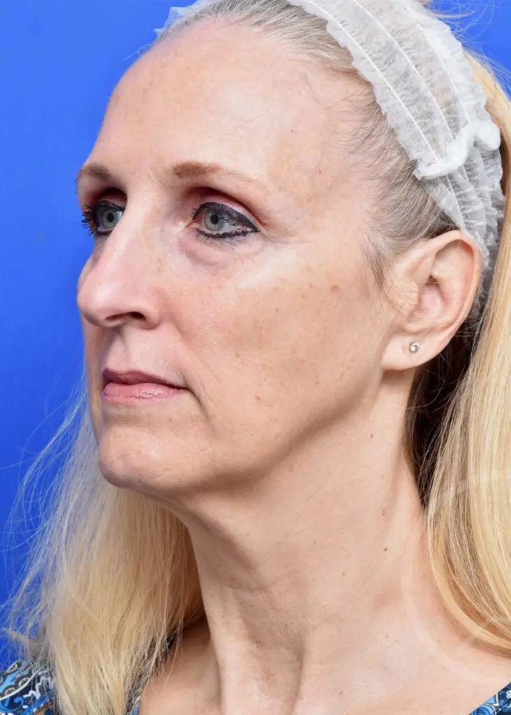 Plastic Surgery Before and After Pictures in Jacksonville, FL - Garcia Facial Plastic Surgery