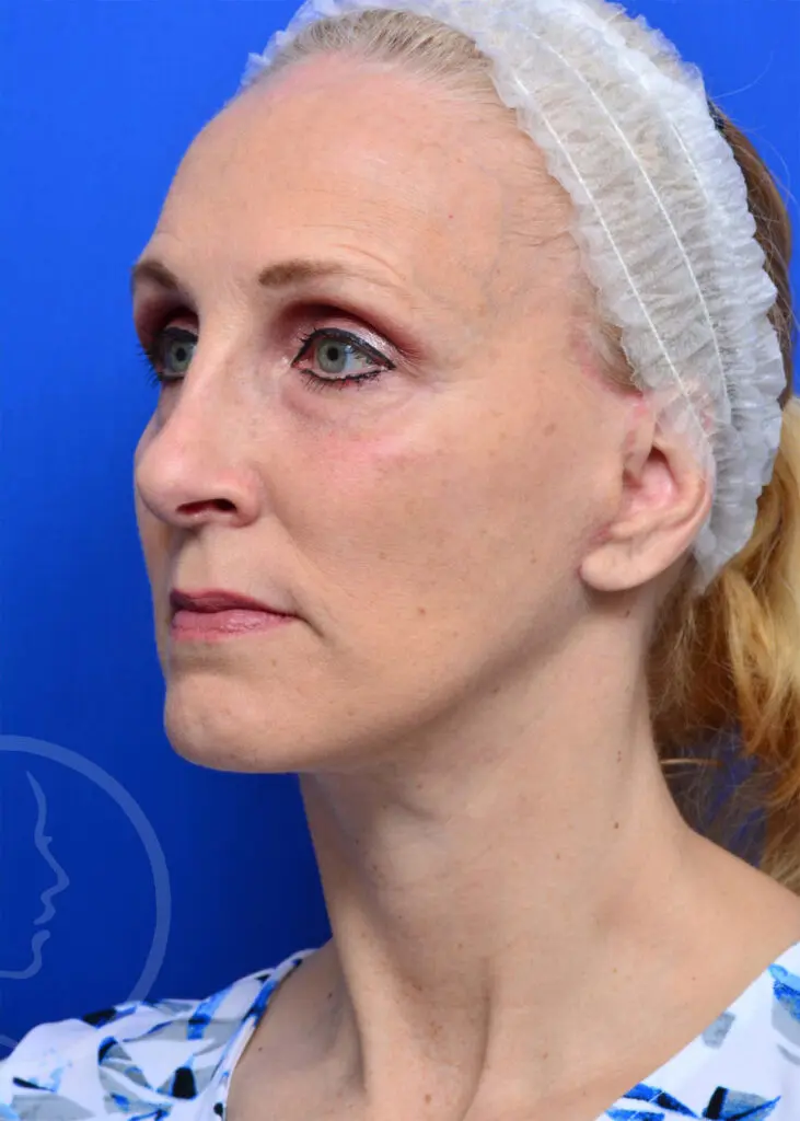 Plastic Surgery Before and After Pictures in Jacksonville, FL - Garcia Facial Plastic Surgery