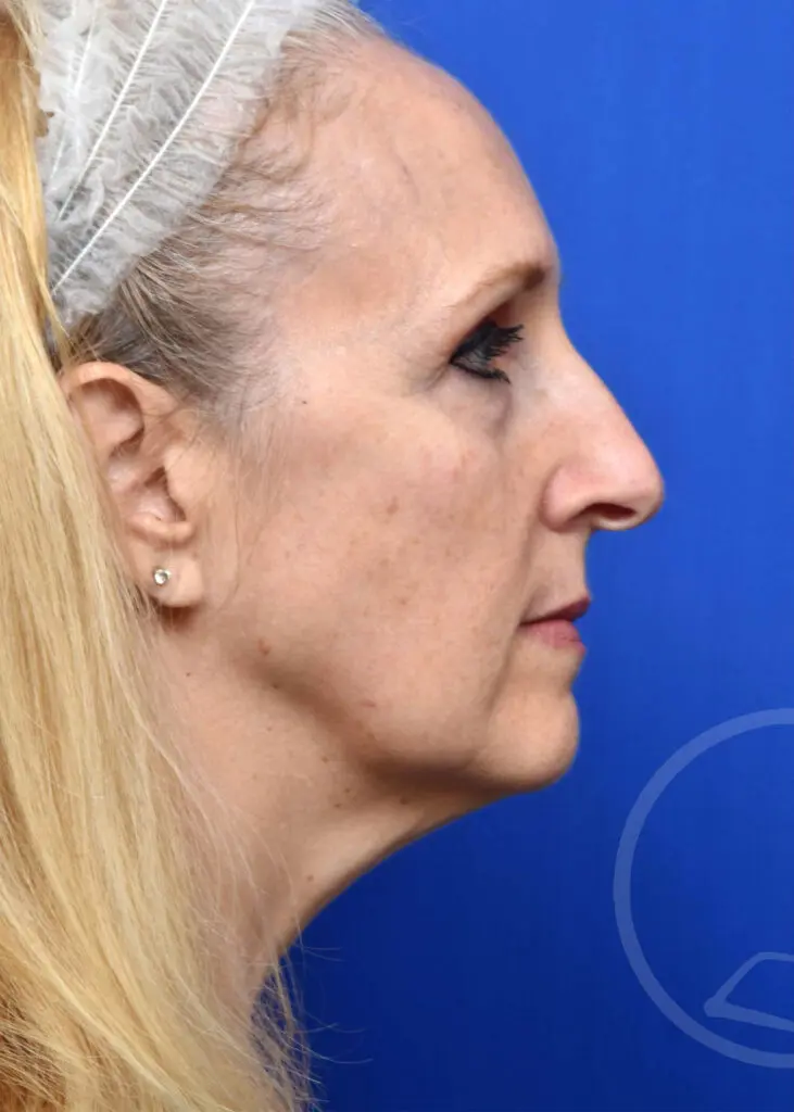 Plastic Surgery Before and After Pictures in Jacksonville, FL - Garcia Facial Plastic Surgery
