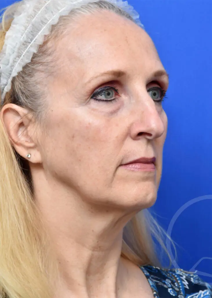 Plastic Surgery Before and After Pictures in Jacksonville, FL - Garcia Facial Plastic Surgery