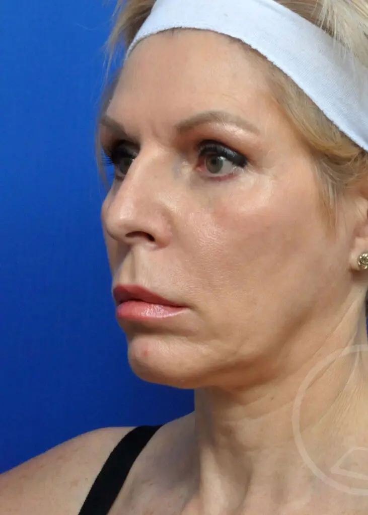 Plastic Surgery Before and After Pictures in Jacksonville, FL - Garcia Facial Plastic Surgery