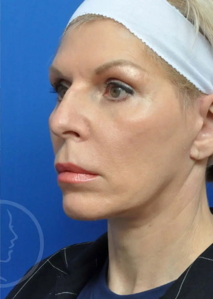 Plastic Surgery Before and After Pictures in Jacksonville, FL - Garcia Facial Plastic Surgery