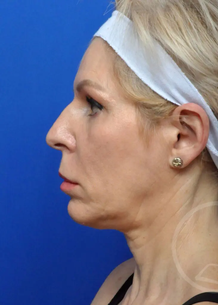 Plastic Surgery Before and After Pictures in Jacksonville, FL - Garcia Facial Plastic Surgery