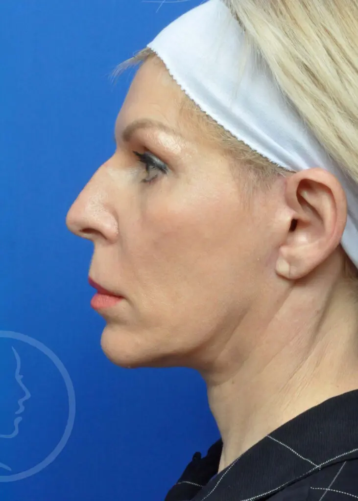 Plastic Surgery Before and After Pictures in Jacksonville, FL - Garcia Facial Plastic Surgery