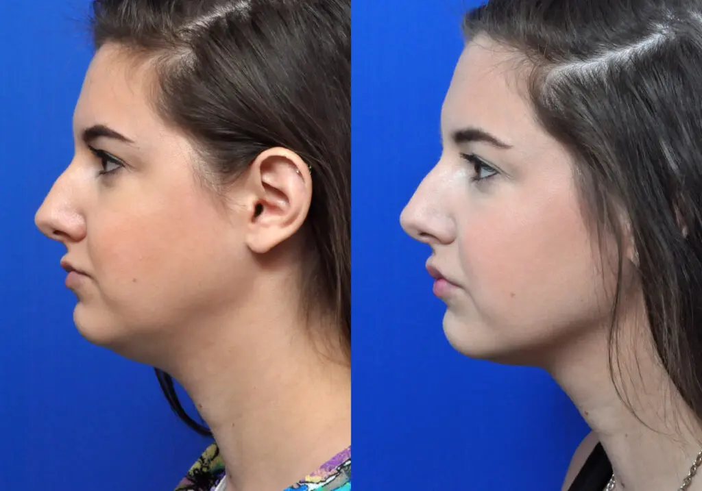 Kybella Before and After Pictures Jacksonville, FL