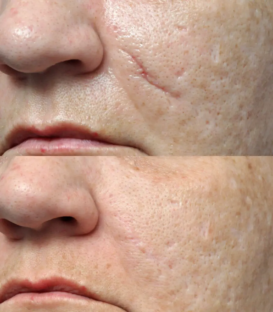 Microneedling in Jacksonville, FL