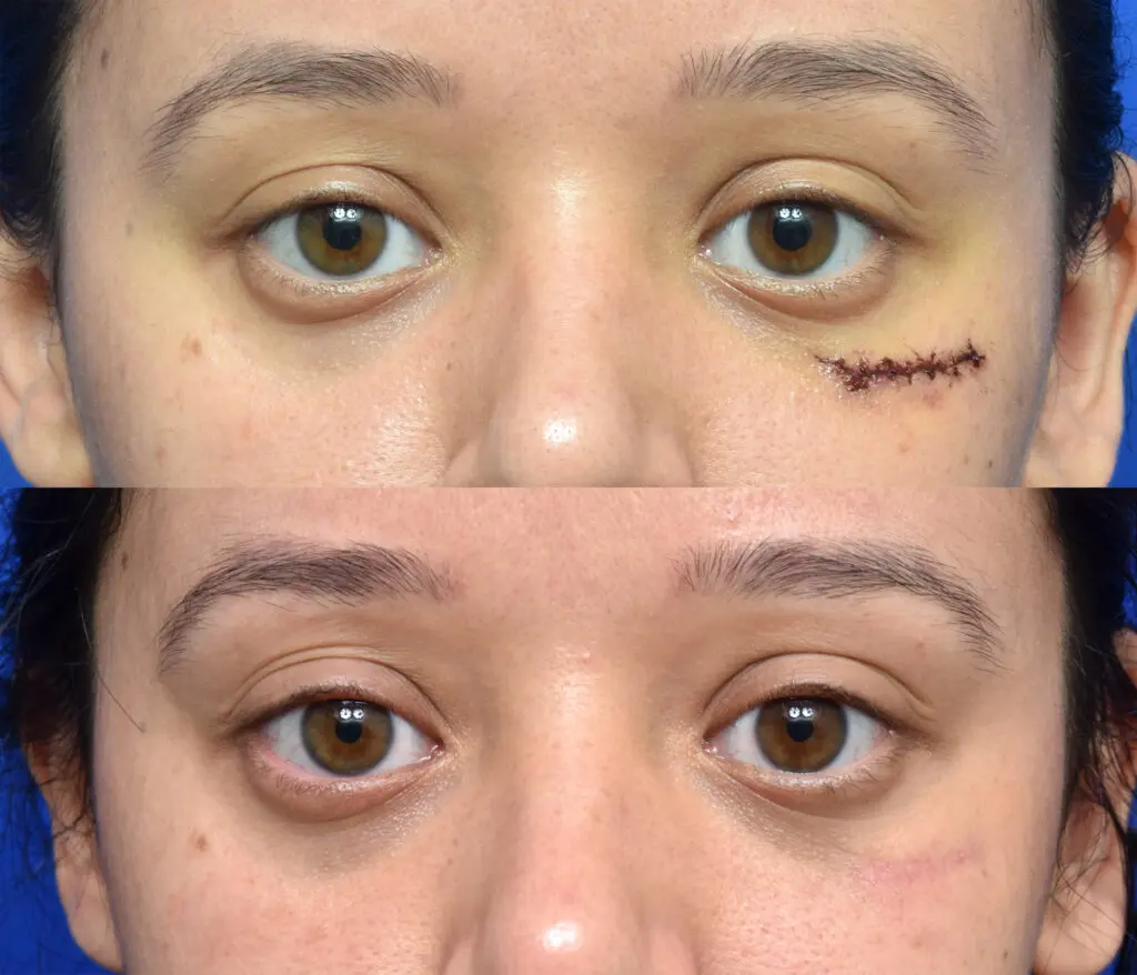 Microneedling in Jacksonville, FL