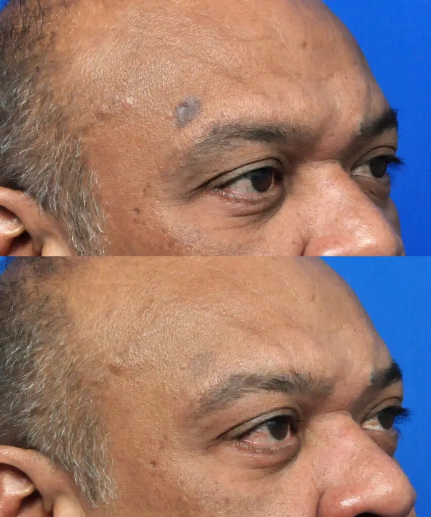 Melasma Therapy with PRF in Jacksonville, FL