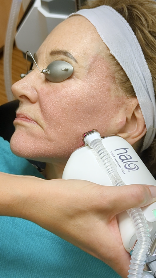 Laser Peels in Jacksonville, FL