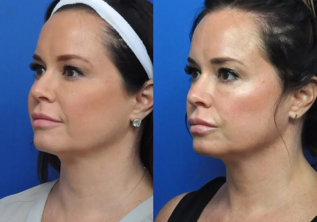 Ultherapy Before and After Pictures in Jacksonville, FL - Garcia Facial Plastic Surgery
