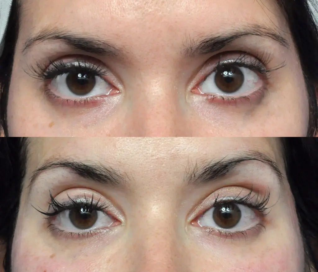 Ultherapy Before and After Pictures in Jacksonville, FL - Garcia Facial Plastic Surgery