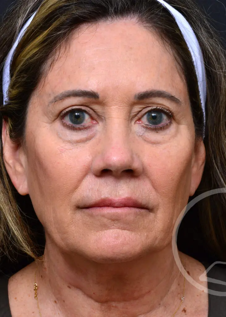 Plastic Surgery Before and After Pictures in Jacksonville, FL - Garcia Facial Plastic Surgery