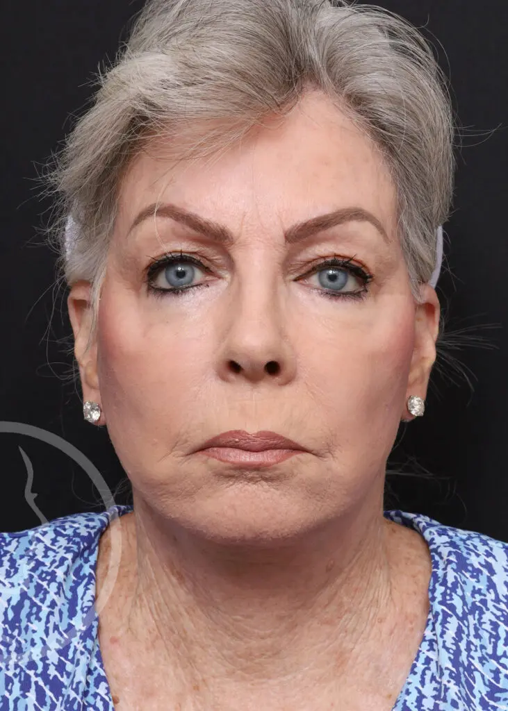 Plastic Surgery Before and After Pictures in Jacksonville, FL - Garcia Facial Plastic Surgery