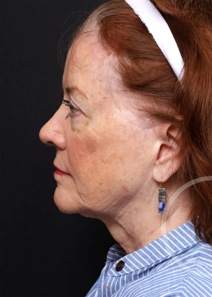 Plastic Surgery Before and After Pictures in Jacksonville, FL - Garcia Facial Plastic Surgery
