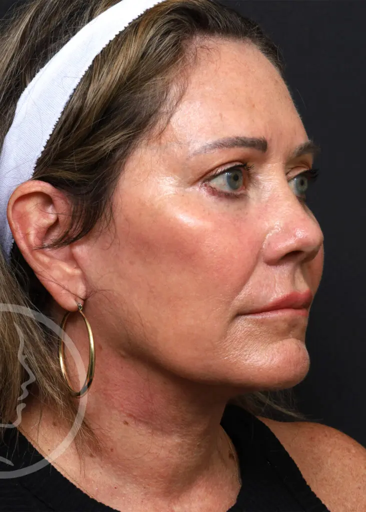 Plastic Surgery Before and After Pictures in Jacksonville, FL - Garcia Facial Plastic Surgery