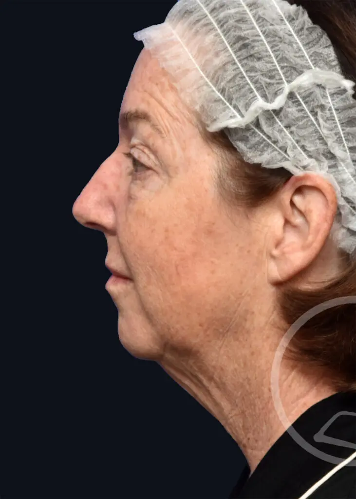 Plastic Surgery Before and After Pictures in Jacksonville, FL - Garcia Facial Plastic Surgery