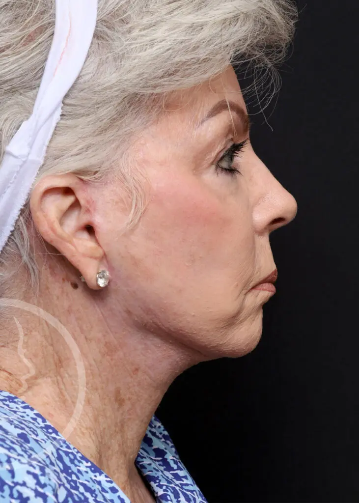 Plastic Surgery Before and After Pictures in Jacksonville, FL - Garcia Facial Plastic Surgery