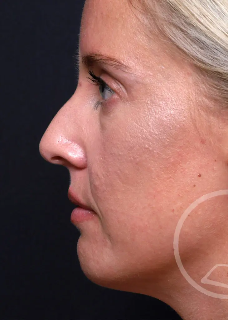 Plastic Surgery Before and After Pictures in Jacksonville, FL - Garcia Facial Plastic Surgery