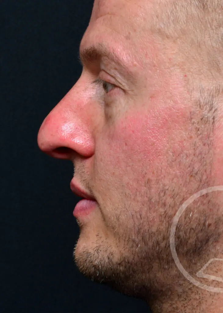 Plastic Surgery Before and After Pictures in Jacksonville, FL - Garcia Facial Plastic Surgery