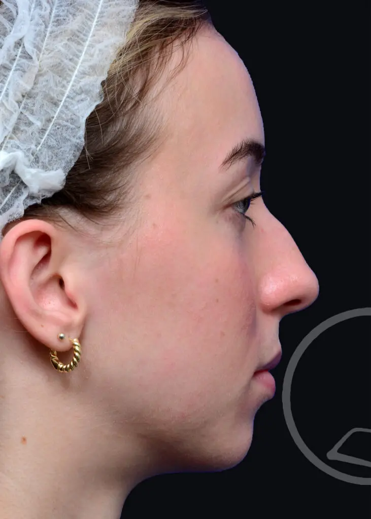 Plastic Surgery Before and After Pictures in Jacksonville, FL - Garcia Facial Plastic Surgery