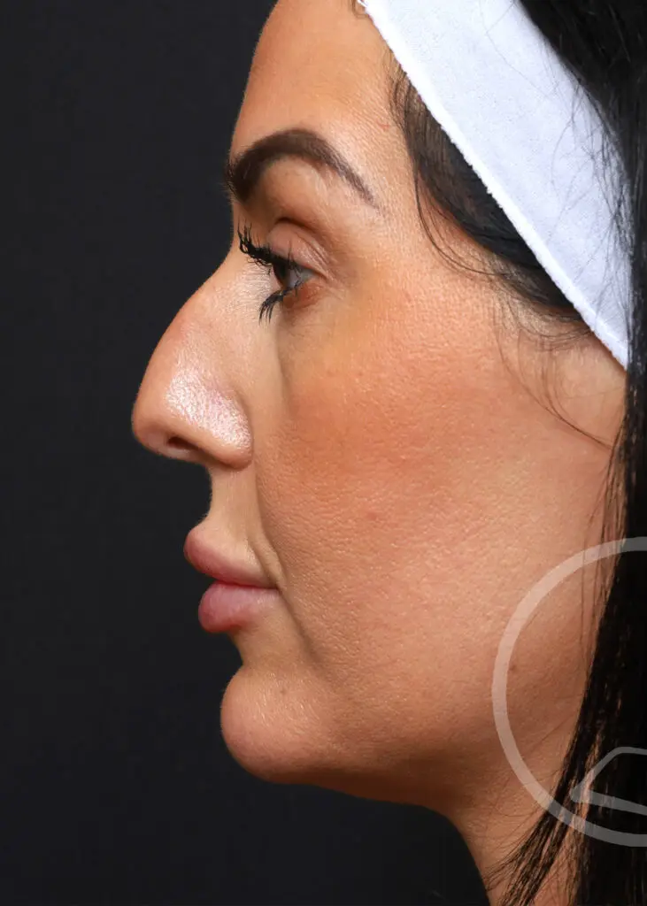 Plastic Surgery Before and After Pictures in Jacksonville, FL - Garcia Facial Plastic Surgery