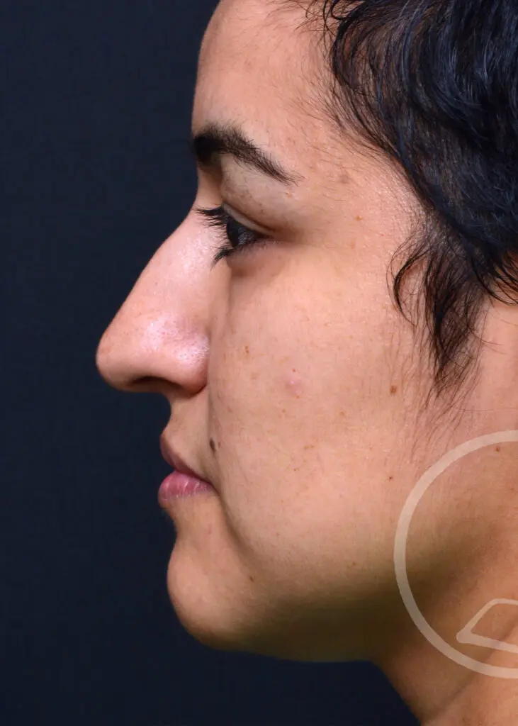 Plastic Surgery Before and After Pictures in Jacksonville, FL - Garcia Facial Plastic Surgery