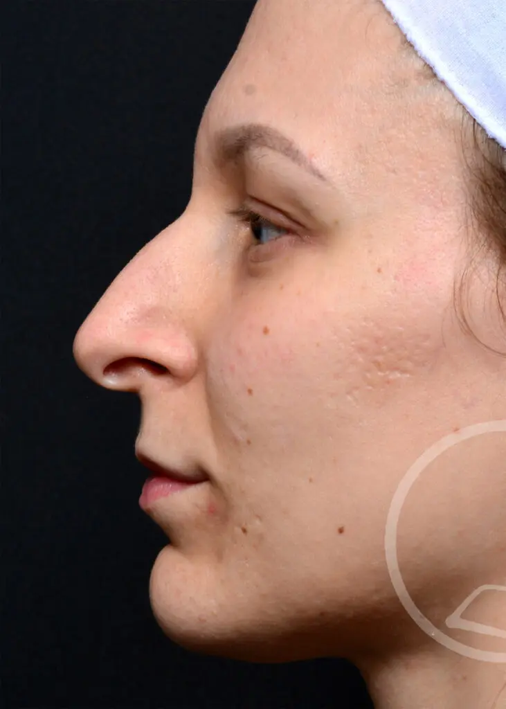 Plastic Surgery Before and After Pictures in Jacksonville, FL - Garcia Facial Plastic Surgery