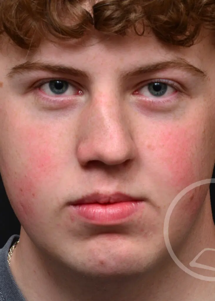 Plastic Surgery Before and After Pictures in Jacksonville, FL - Garcia Facial Plastic Surgery