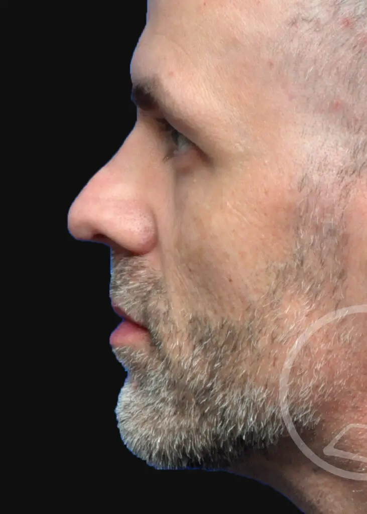 Plastic Surgery Before and After Pictures in Jacksonville, FL - Garcia Facial Plastic Surgery