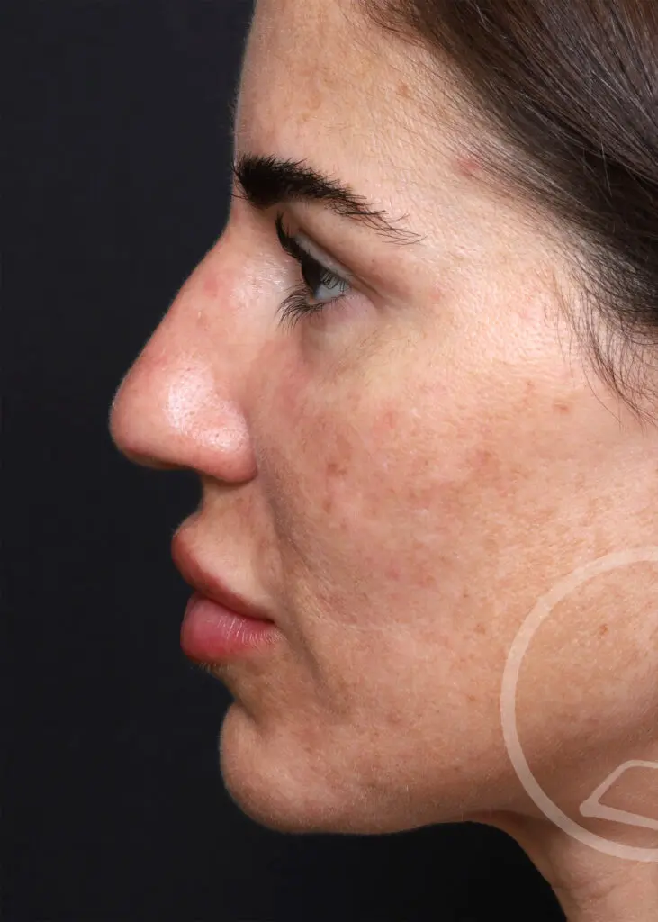 Plastic Surgery Before and After Pictures in Jacksonville, FL - Garcia Facial Plastic Surgery