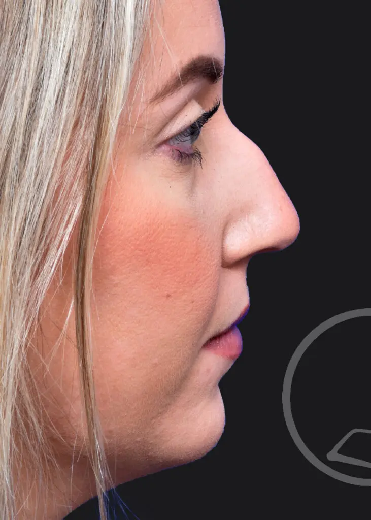 Plastic Surgery Before and After Pictures in Jacksonville, FL - Garcia Facial Plastic Surgery