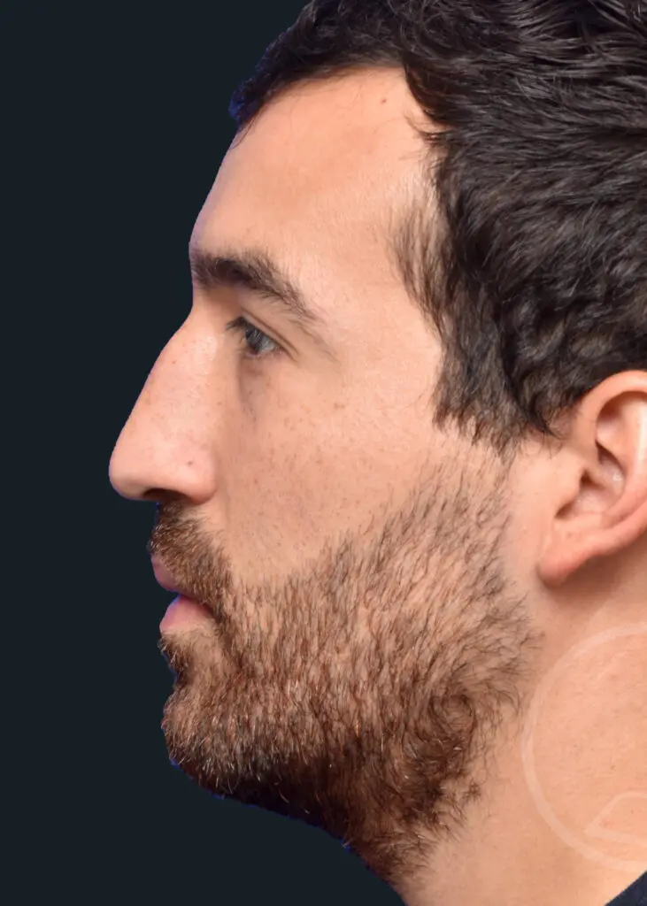 Plastic Surgery Before and After Pictures in Jacksonville, FL - Garcia Facial Plastic Surgery