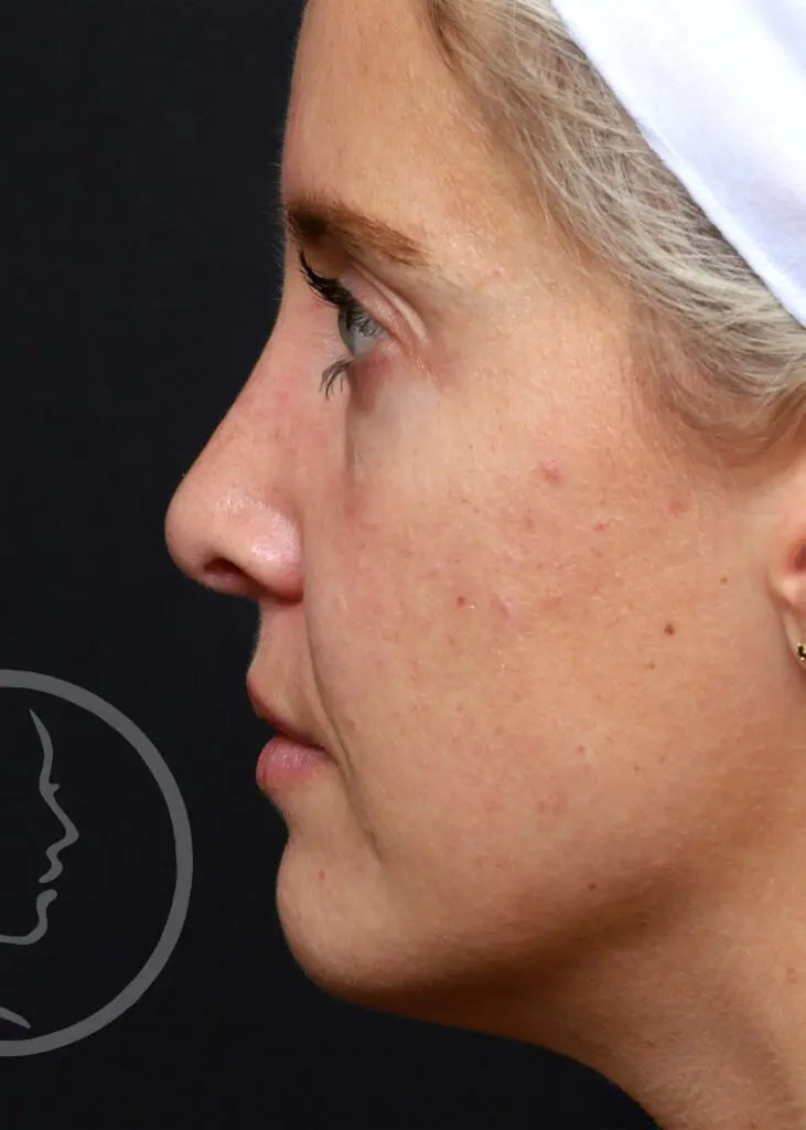 Plastic Surgery Before and After Pictures in Jacksonville, FL - Garcia Facial Plastic Surgery