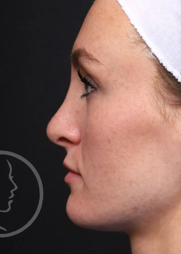 Plastic Surgery Before and After Pictures in Jacksonville, FL - Garcia Facial Plastic Surgery