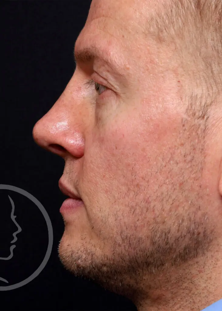 Plastic Surgery Before and After Pictures in Jacksonville, FL - Garcia Facial Plastic Surgery