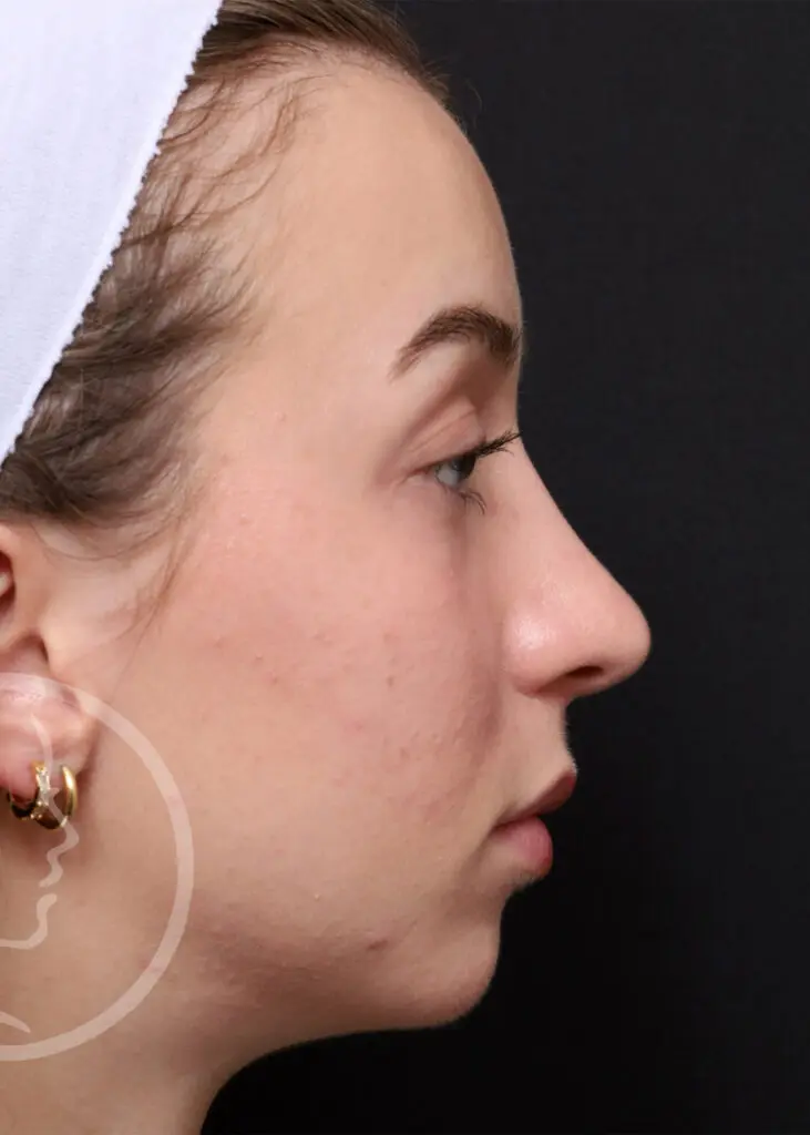 Plastic Surgery Before and After Pictures in Jacksonville, FL - Garcia Facial Plastic Surgery