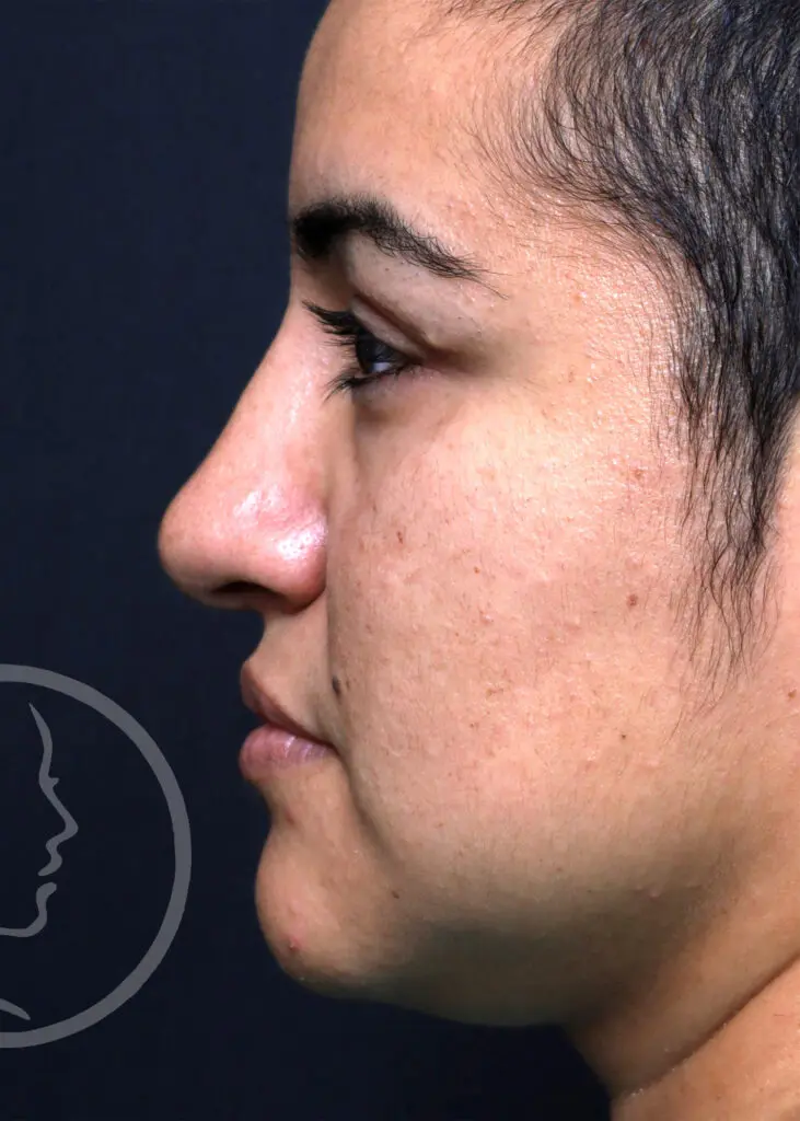 Plastic Surgery Before and After Pictures in Jacksonville, FL - Garcia Facial Plastic Surgery