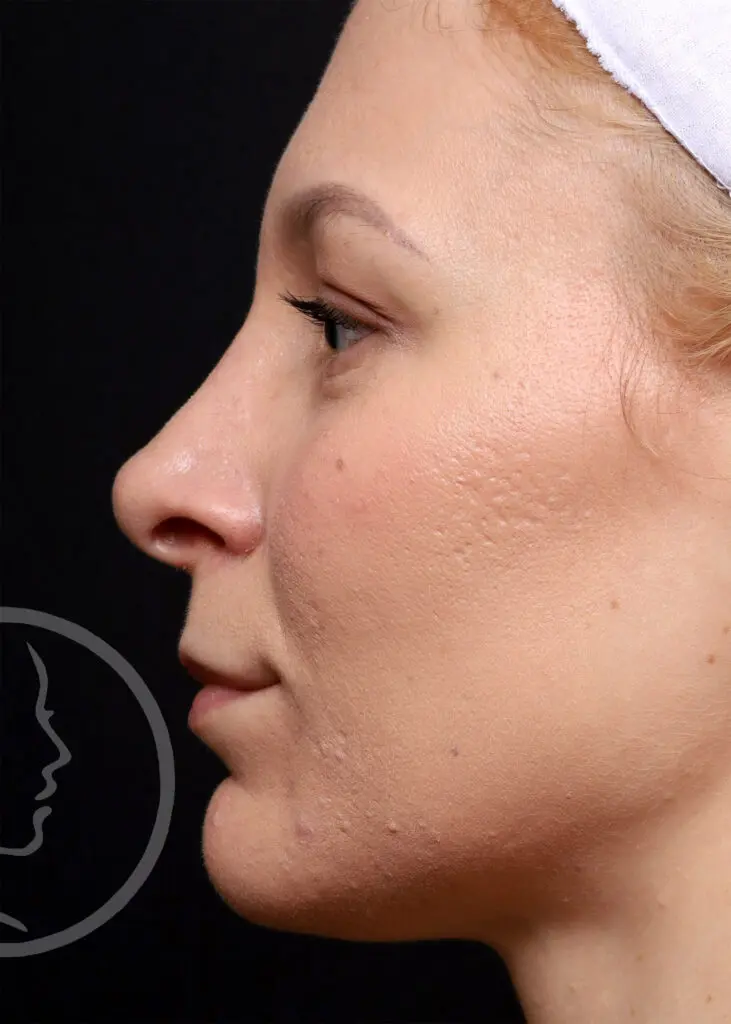 Plastic Surgery Before and After Pictures in Jacksonville, FL - Garcia Facial Plastic Surgery