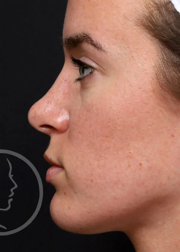 Plastic Surgery Before and After Pictures in Jacksonville, FL - Garcia Facial Plastic Surgery